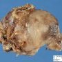Abdominal cystic lymphangioma