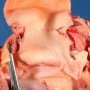 Aortic dissection in Marfan disease