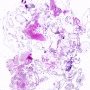 Complete hydatiform mole