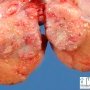 Testicular embryonal carcinoma