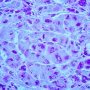 Polyglycosan inclusions in glycogen storage disease type 4 (GSD4)