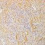 Granuloma annulare