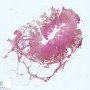 Lymphangiomyoma (lymphangioleiomyoma)