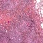 Pulmonary nodular lymphoid hyperplasia
