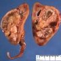 Botryoid Wilms tumor