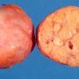 Ovarian juvenile granulosa tumor