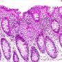 Granulomatous colitis in Crohn disease