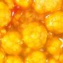 Cholelithiasis