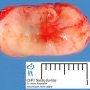 Intradural extramedullary schwannoma