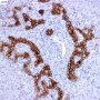 Ductular proliferation in North American Indian cirrhosis (CK19)