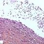 Salivary mucocele