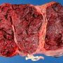 Trichorionic triamniotic placenta