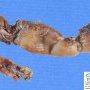 Volvulus-associated intestinal atresia