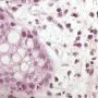 Inflammatory apoptotic cells in chronic colitis