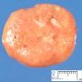 Nodal Castleman disease