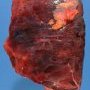 Hemorrhagic infectious pneumonia