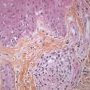 Dermal epithelioid granulomas