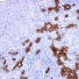 Ductular proliferation in North American Indian cirrhosis (CK19)