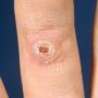 Digital epithelioid dermatofibroma