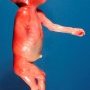 Humeral meromelia (fetus, 21 weeks)