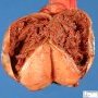 Paratesticular hematoma