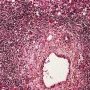 Periportal hematopoiesis (Fetus, 32 weeks)