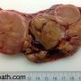Thymoma, type A