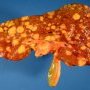 Hepatic tumoral invasion by a Hodgkin lymphoma