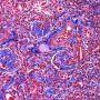 WT1-associated diffuse mesangial sclerosis