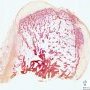 Osteochondroma