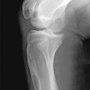 From Bullough's Orthopaedic Pathology