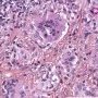 Nodal cryptococcosis (Cryptococcus neoformans)