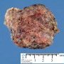 Retropancreatic cystic lymphangioma