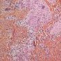 Dermal epithelioid granulomas