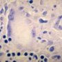 Ziehl–Neelsen stain (Courtesy of Dr Yale Rosen)