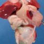 Unilateral renal agenesis, rectovesical fisula, anorectal atresia