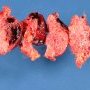 Placental section with an hematoma