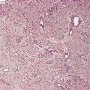 Juvenile angiofibroma