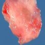 Invasive pulmonary aspergillosis