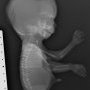 Caudal dysplasia with limb agenesis