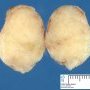 Mammary fibroadenoma
