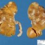 Small Wilms tumor at the superior pole