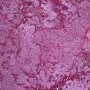 Immature paraganglioma of the vesical region