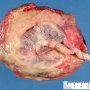 Total placenta circumvallata