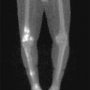 From Bullough's Orthopaedic Pathology