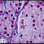 Portal lipid-laden macrophages in CESD-Wolman disease