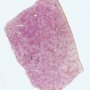 Hepatic steatosis