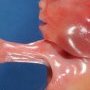 Upper limb pterygium