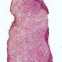 Nasal inflammatory pseudopolyp
