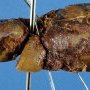 Hepatic ischemia in a liver allograft